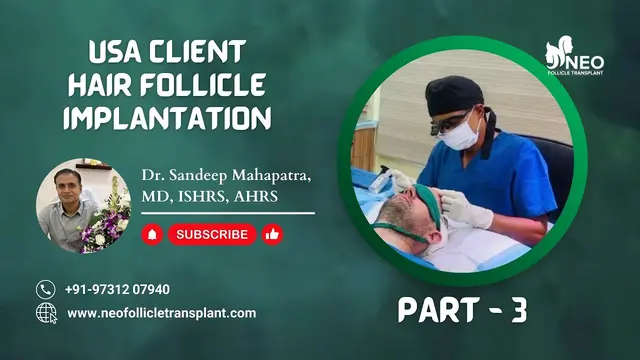 Best hair loss consultant Bangalore India | NFT Implantation | US Client #international Client