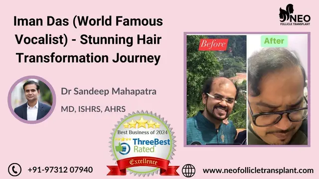 Iman Das - Famous Vocalist- Stunning Hair Transformation Journey | Best Hair Transplant in Bangalore