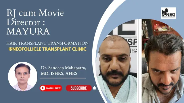 Mayura, RJ & movie director; Hair transformation | Hair transplant result | #hairtransplantjourney