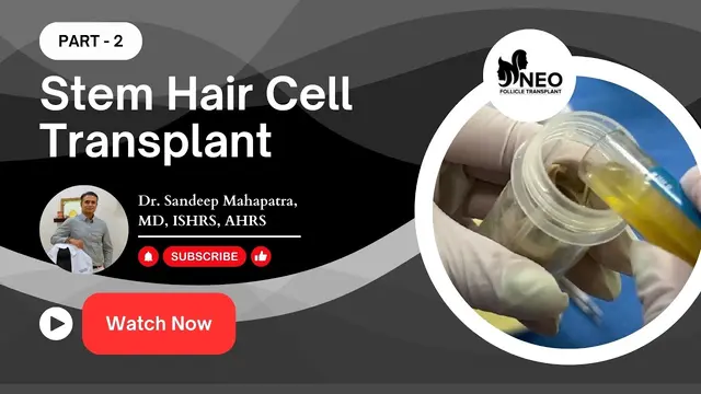 Stem Cell Hair Transplant Bangalore| Hair Transplant For Foreign National at NEO Follicle Transplant