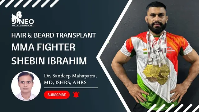 Hair Transplant Result | Beard Transplant Result | Best Hair Transplant | MMAfighter Shebin Ibrahim