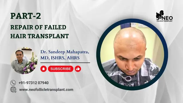 Hair Transplant Repair - Part 2 | Hair Transplant Consultation | Hair Loss Treatment | #hairlosscure