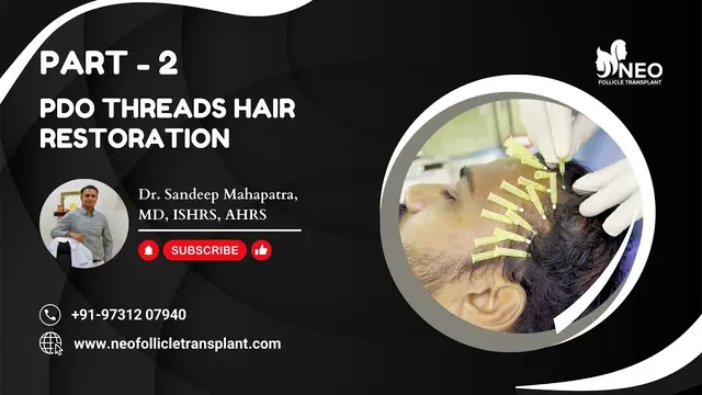 PDO Threads for Hair | Hair Transplant Surgeon in Bangalore | Hair loss Treatment Bangalore|