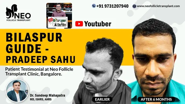 Hair Transplant Journey After 6 Months ⁨@BilaspurGuide⁩  | Best Hair Transplant clinic Bangalore.