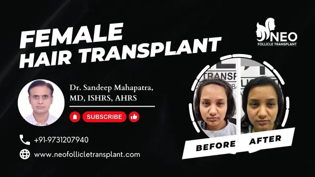 Female Hair Transplant in Bangalore | Hair Transplant in Women | Hair Transplant in India for Female