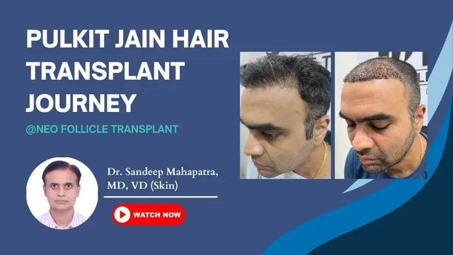 Best Hair Transplant In Bangalore | Hair transplant consult in Bangalore | #hairtransplantresults