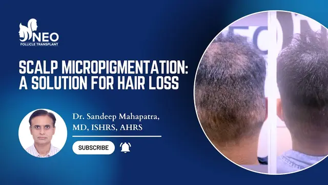 Best solution for hair loss | Scalp Micropigmentation | best hair transplant in Bangalore
