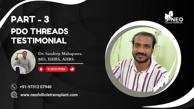 PDO Threads for Hair | Threads | Hair Transplant cost in India | Hair transplant in Bangalore |