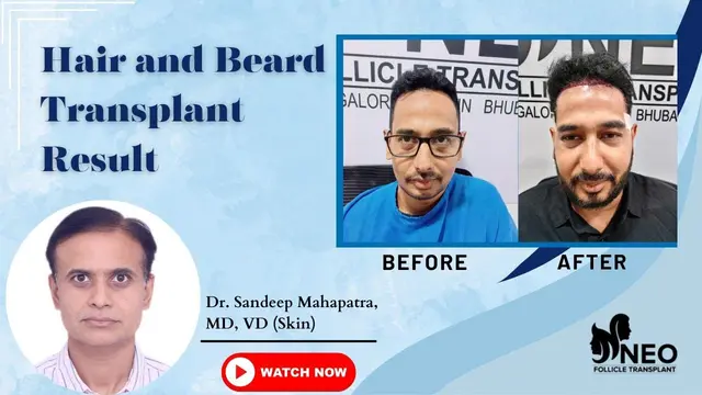 Hair Transplant In Bangalore | Beard Transplant | Best Results of Hair Transplant In Bangalore