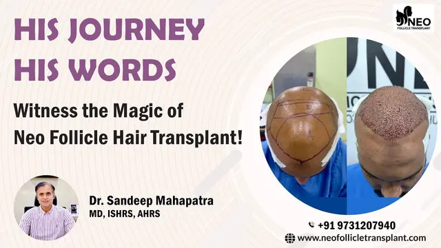 His Journey, His Words! Witness the Magic of Neo Follicle Hair Transplant in Bangalore