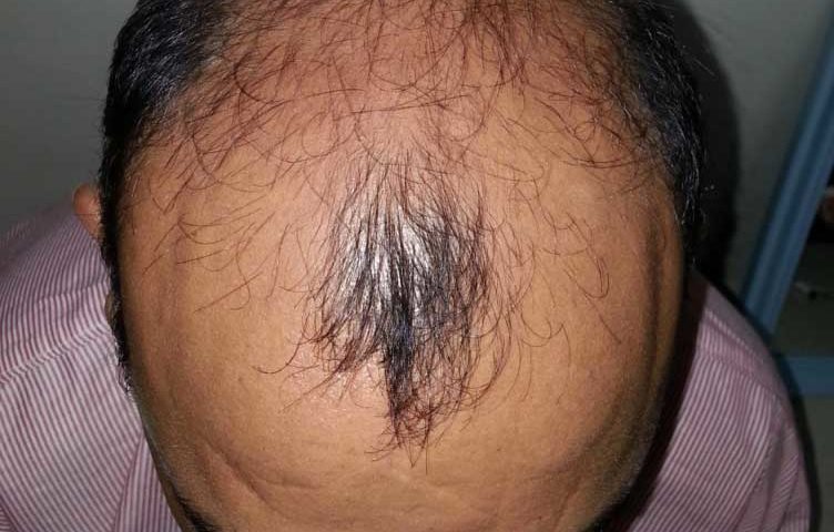 Factors Affect Hair Growth After Transplant
