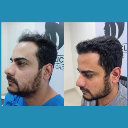 Hair Transplant For Male