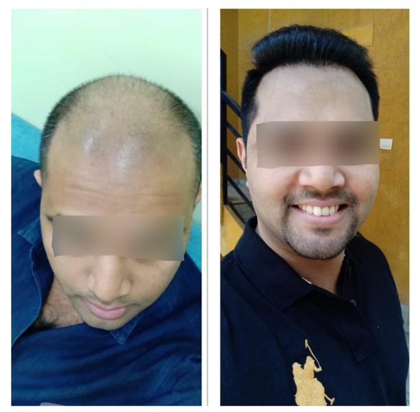  Hair Transplant Results 