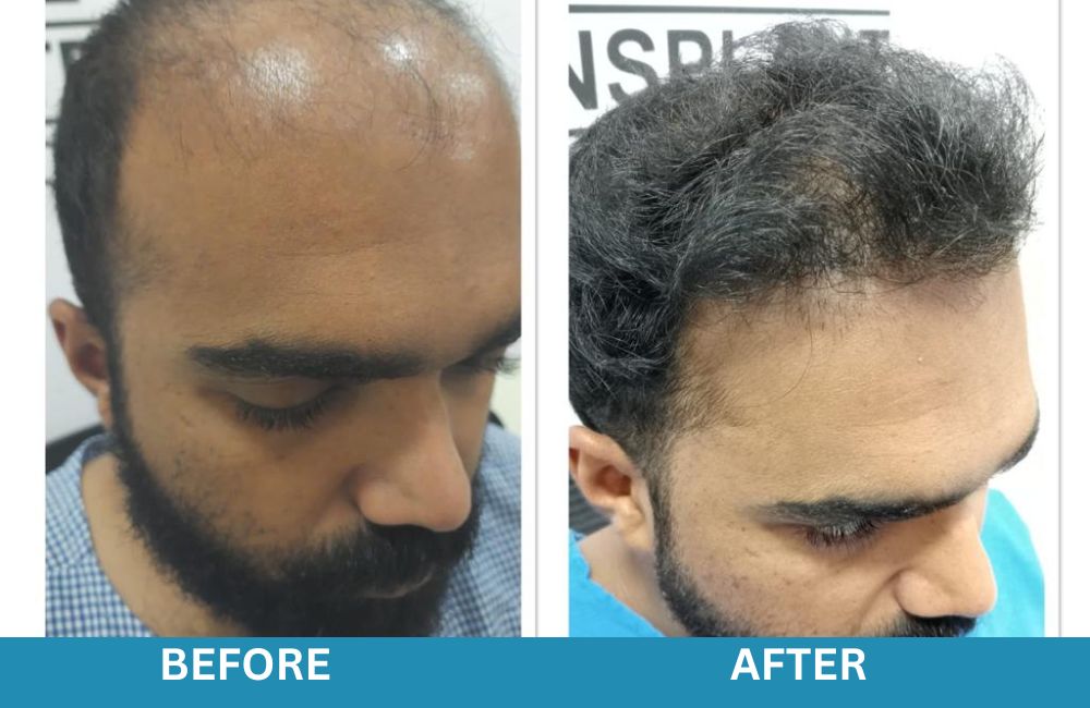 Factors affecting the cost of Hair Transplant