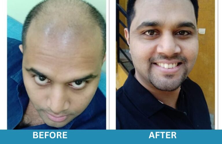 Hair Transplant for Male in Bangalore | Neo Follicle Hair Transplant