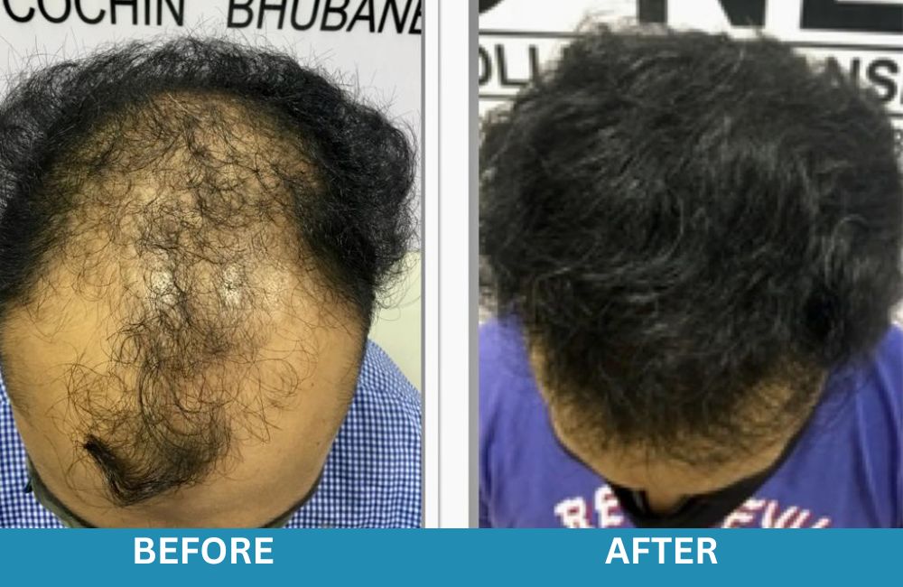 Hair Transplant After Care and Recovery