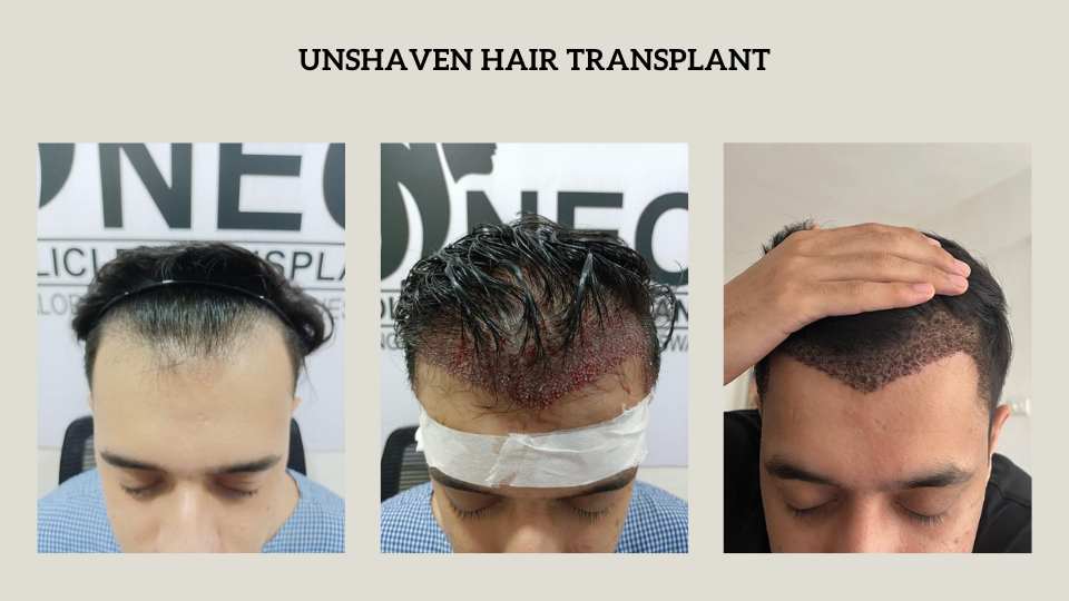 Unshaven Hair Transplant