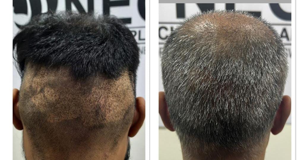 Why Foreign Nationals Preferred Hair Transplant in India?
