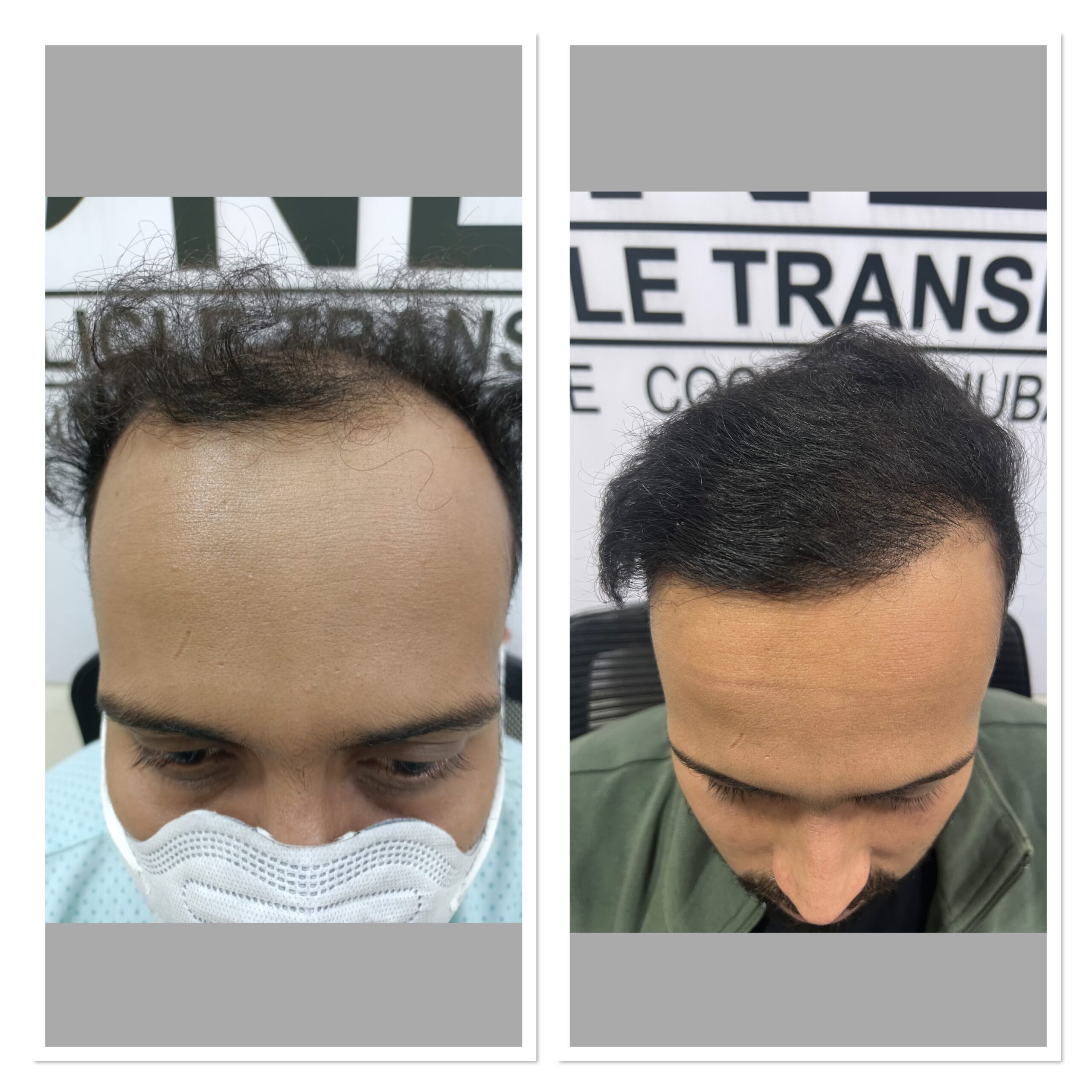 Elevate Your Summer Style with a Hair Transplant Consultation in India